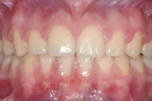 Before-and-after comparison of orthodontic treatment results, showcasing straightened teeth and improved smile alignment at True Smile Orthodontics.