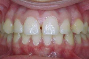 Before orthodontic treatment image showing misaligned teeth with visible gaps and gum redness, reflecting True Smile Orthodontics' focus on smile transformations.